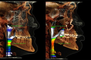 Orthognathic surgery case CT-Scan before and after