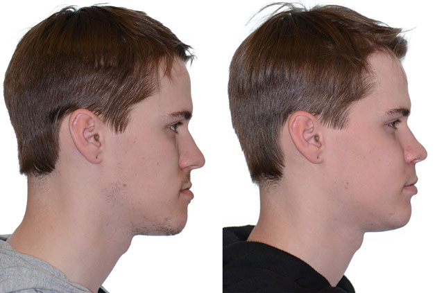 Photographs of the orthognathic surgery patient profile view with no smile