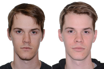 Orthognathic surgery three quaters view Before and After with no smile