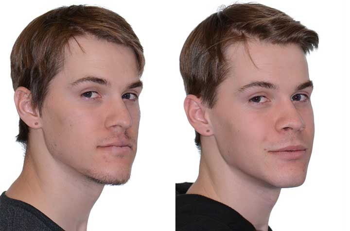 Orthognathic Surgery With Bone Grafting - Corrective Jaw Surgery - Dr