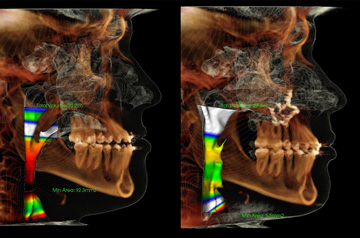 Orthognathic surgery case CT-Scan before and after