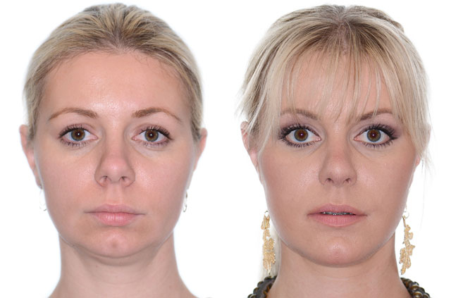 Orthognathic surgery frontal view Before and After with no smile