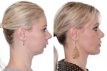 Photographs of the orthognathic surgery patient profile view with no smile