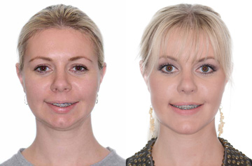 Orthognathic surgery frontal view Before and After with smile