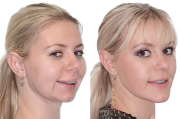 Orthognathic surgery three quaters view Before and After with smile