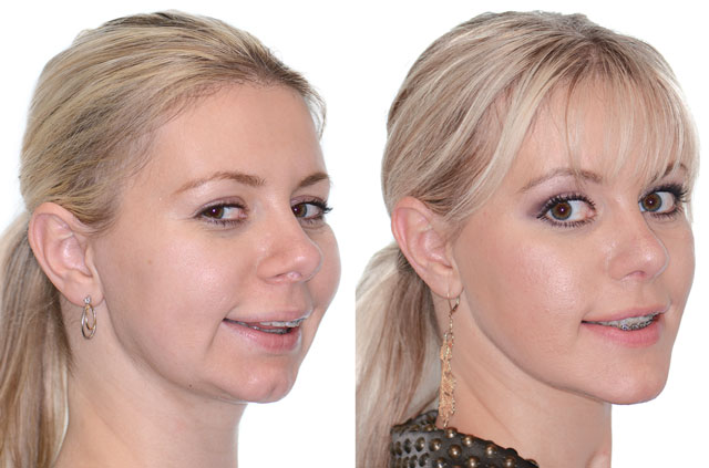 Corrective Jaw Surgery Complete Face Makeover - Corrective Jaw Surgery