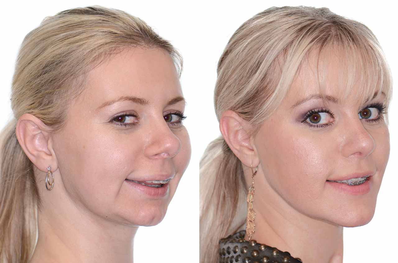 Corrective Jaw Surgery Complete Face Makeover Corrective Jaw Surgery 