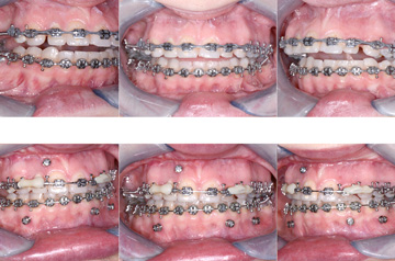 Orthognathic surgery results bite befor and after