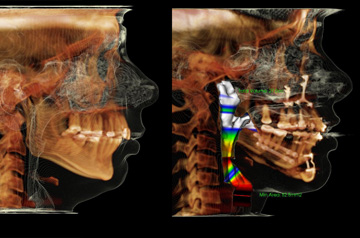 Orthognathic surgery case CT-Scan before and after