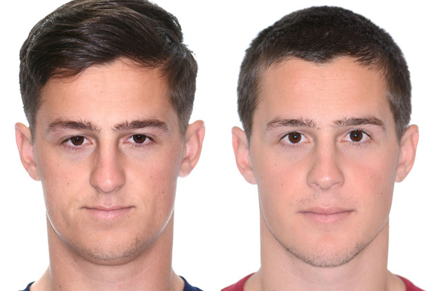 Photographs of the orthognathic surgery patient frontal view with no smile before and after