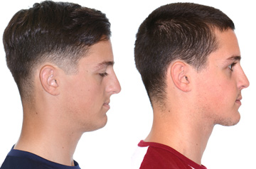 Photographs of the orthognathic surgery patient profile view with no smile before and after