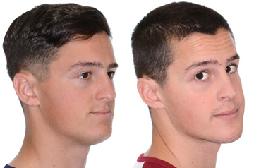 Photographs of the orthognathic surgery patient three-quaters angle view with no smile before and after