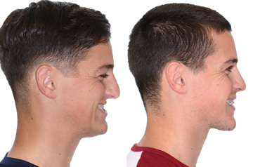 Photographs of the orthognathic surgery patient profile view withsmile before and after