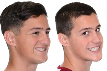Photographs of the orthognathic surgery patient three-quaters angle view with smile before and after