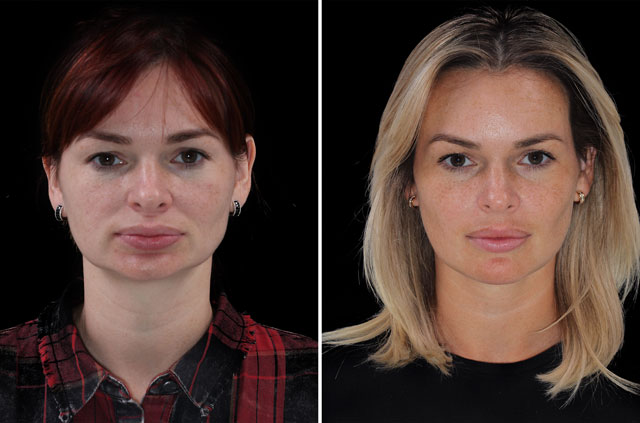 Photographs of the orthognathic surgery patient three-quaters angle view with no smile before and after