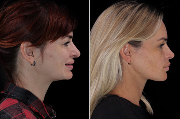 Photographs of the orthognathic surgery patient right profile view with smile before and after