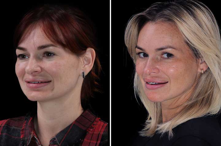 Удлинение и выдвижение лица — эстетическая хирургия челюстей — дополнительный ракурс до и после 2