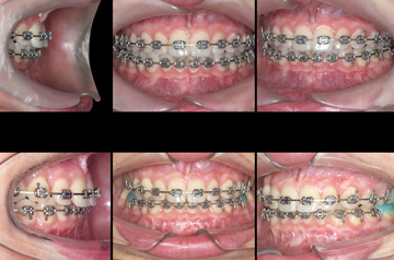 Photographs of the orthognathic surgery patient bite before and after