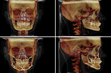 Photographs of the orthognathic surgery patient frontal and profile CT-Scan before and after