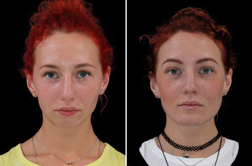 Photographs of the orthognathic surgery patient three-quaters angle view with no smile before and after
