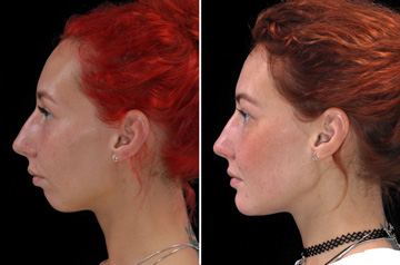 Photographs of the orthognathic surgery patient right profile view with smile before and after