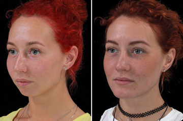 Photographs of the orthognathic surgery patient frontal view with no smile before and after