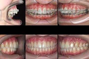 Photographs of the orthognathic surgery patient bite before and after