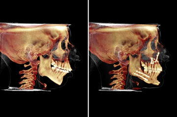 Photographs of the orthognathic surgery patient frontal and profile CT-Scan before and after