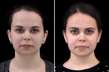 Photographs of the orthognathic surgery patient three-quaters angle view with no smile before and after