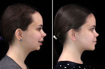 Photographs of the orthognathic surgery patient right profile view with smile before and after