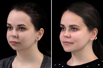 Photographs of the orthognathic surgery patient frontal view with no smile before and after