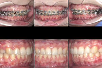 Photographs of the orthognathic surgery patient bite before and after