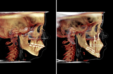 Photographs of the orthognathic surgery patient frontal and profile CT-Scan before and after