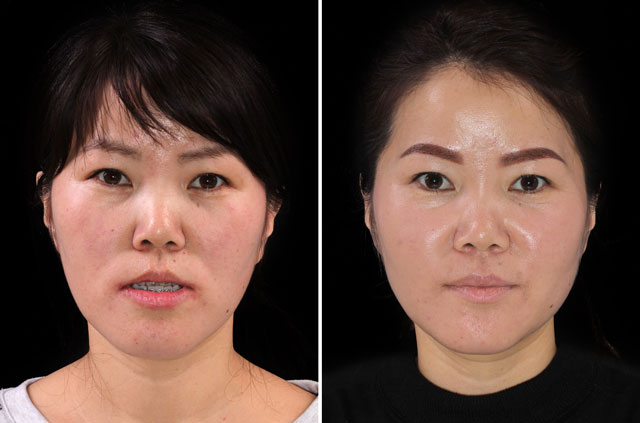 Photographs of the orthognathic surgery patient three-quaters angle view with no smile before and after