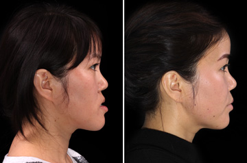 Photographs of the orthognathic surgery patient right profile view with smile before and after