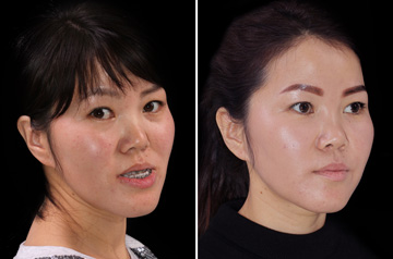 Photographs of the orthognathic surgery patient frontal view with no smile before and after