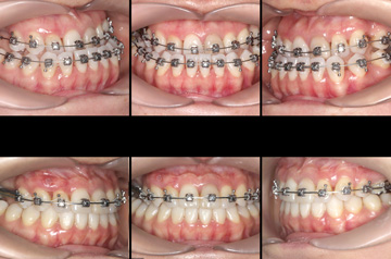 Photographs of the orthognathic surgery patient bite before and after
