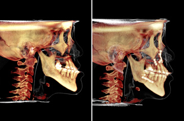 Photographs of the orthognathic surgery patient frontal and profile CT-Scan before and after