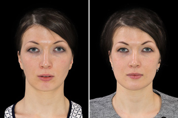 Photographs of the orthognathic surgery patient three-quaters angle view with no smile before and after