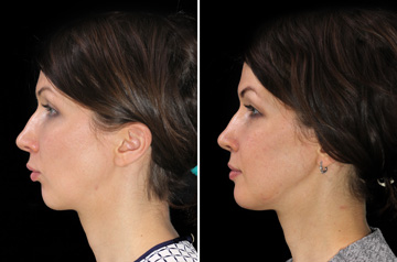 Photographs of the orthognathic surgery patient right profile view with smile before and after
