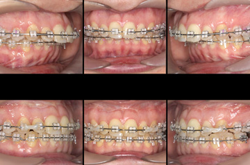 Photographs of the orthognathic surgery patient bite before and after