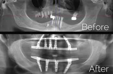 All-on-4 and Teeth-in-a-Day™ CT-Scan "Before" and "After" Dental Implant Case