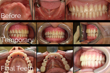 All-on-4 Teeth-in-a-Day™ Before, Temporary, and Final Teeth Bite Picture