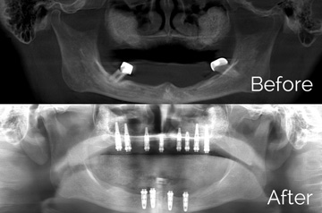 All-on-4 Teeth-in-a-Day™ CT Scan "Before" and "After" View