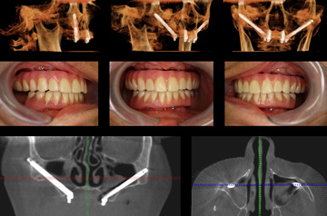 Zigoma dental implant case bite, CT-Scan and 3d imaging