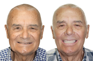 Immediate Implants and Teeth Frontal View "Before" and "After"