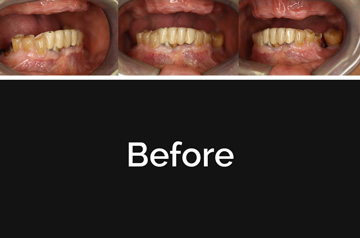 Bite Before Immediate Implants and Teeth