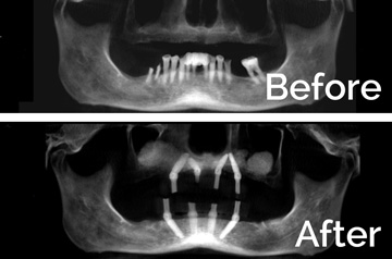Immediate Implants and Teeth CT Scan "Before" and "After"