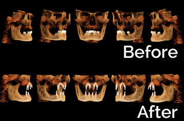 Immediate Implants and Teeth 3D View "Before" and "After"