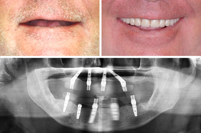 Immediate Implants and Teeth Frontal View "Before" and "After"